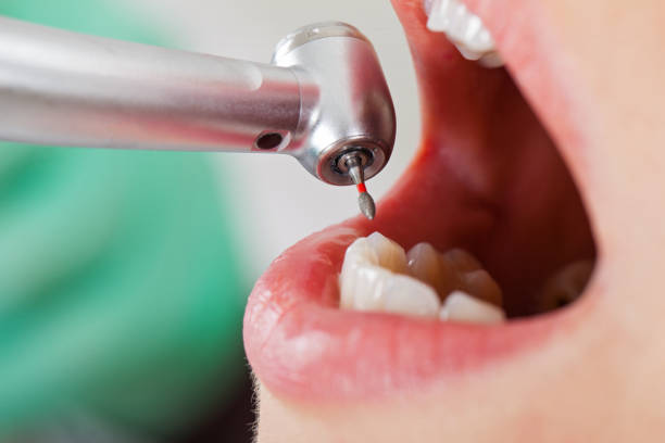Best Emergency Wisdom Teeth Removal in Harbor Hills, OH